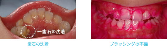 歯周病の原因