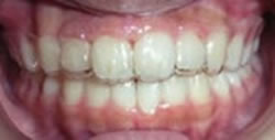 マウスピース矯正 装置が目立たない矯正 口コミ歯科 歯医者