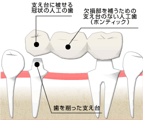 ブリッジ