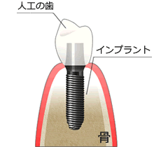 他の歯を削る必要がない