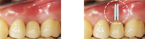 破線円の位置にインプラントが埋まっています