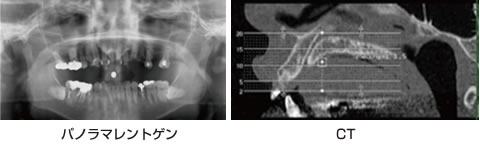 パノラマレントゲンとＣＴ