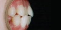 上下の出っ歯（両突歯列）