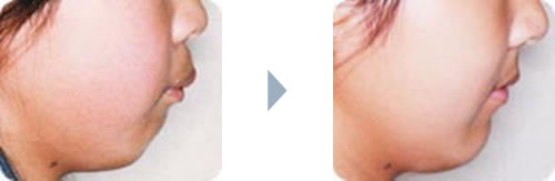 症例1：出っ歯（上顎前突）側貌