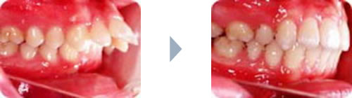 症例1：出っ歯（上顎前突）右側