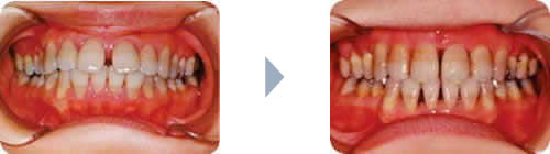症例1：上下の出っ歯（両突歯列）正面