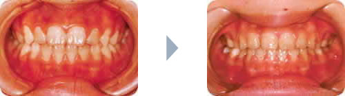症例2：上下の出っ歯（両突歯列）正面