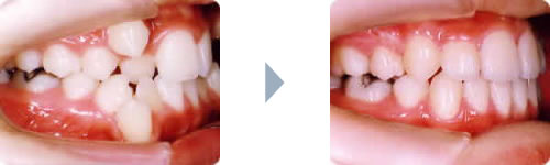 症例3:叢生（乱杭歯、八重歯）