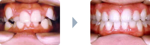 症例4:叢生（乱杭歯、八重歯）