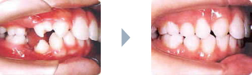 症例1：出っ歯（上顎前突）側貌