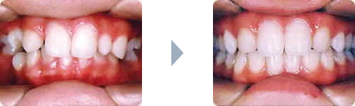 症例1：出っ歯（上顎前突）右側