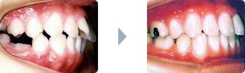症例2：出っ歯（上顎前突）側貌