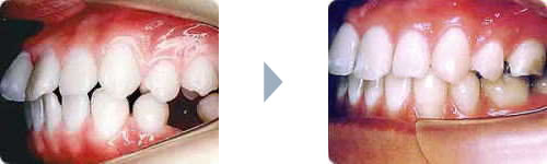 症例2：出っ歯（上顎前突）右側