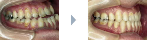 症例1：顎変形症 右側