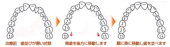 奥歯を後方移動する方法