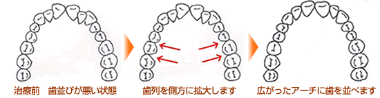 歯列を拡大する方法