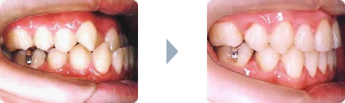 症例2:受け口（下顎前突）・反対咬合