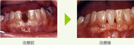 抜けた前歯をつくる治療例