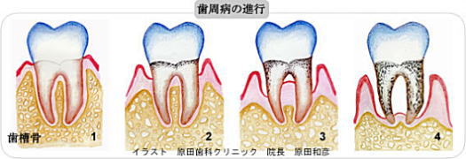 歯周病の進行